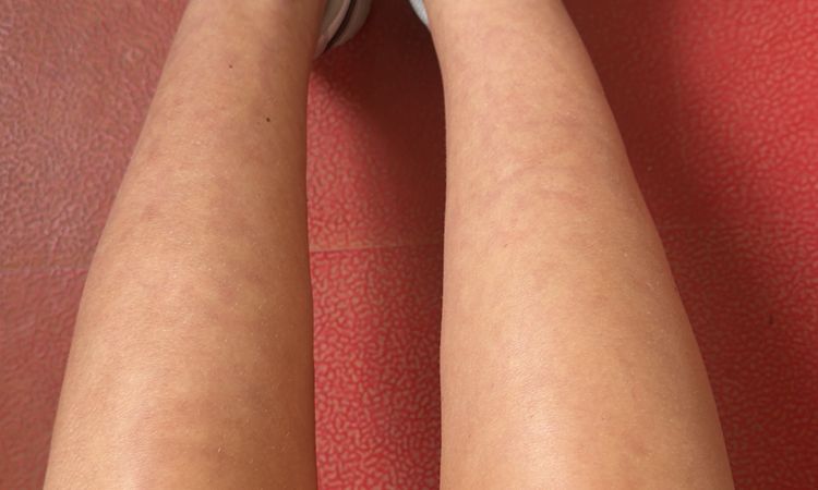 Unebenheiten nach Lipödem-Liposuktion - 82129