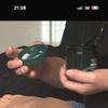Unebenheiten nach Lipödem-Liposuktion
