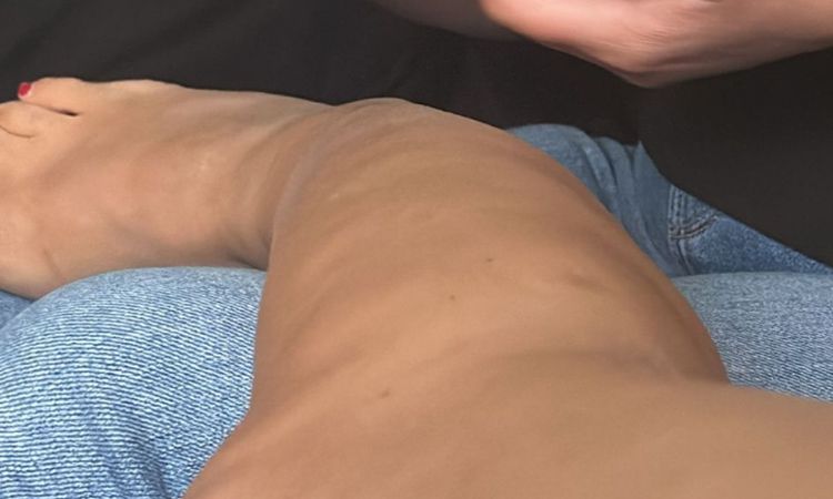 Unebenheiten nach Lipödem-Liposuktion - 82131