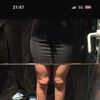 Unebenheiten nach Lipödem-Liposuktion