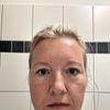 Asymmetrische Augenform & veränderter Gesichtsausdruck nach Oberlidstraffung