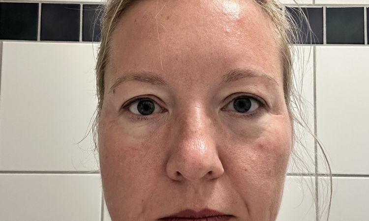 Asymmetrische Augenform & veränderter Gesichtsausdruck nach Oberlidstraffung - 82147