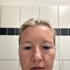 Asymmetrische Augenform & veränderter Gesichtsausdruck nach Oberlidstraffung