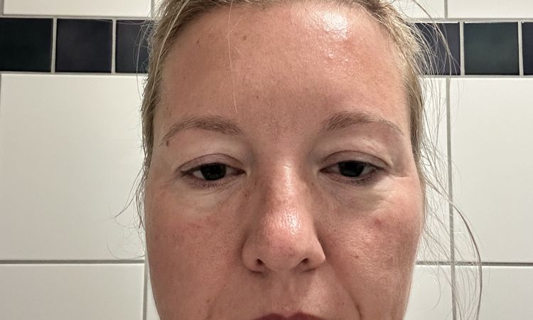 Asymmetrische Augenform & veränderter Gesichtsausdruck nach Oberlidstraffung - 82148
