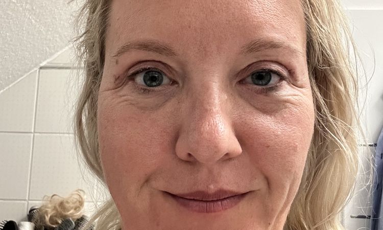Asymmetrische Augenform & veränderter Gesichtsausdruck nach Oberlidstraffung - 82149