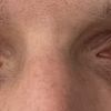 Hat die Asymmetrie meiner Augen einen Grund / Gibt es eine Behandlung?