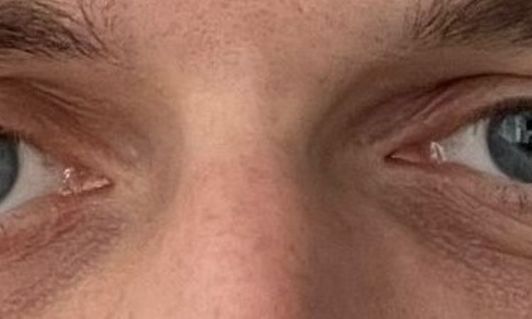 Hat die Asymmetrie meiner Augen einen Grund / Gibt es eine Behandlung? - 82171