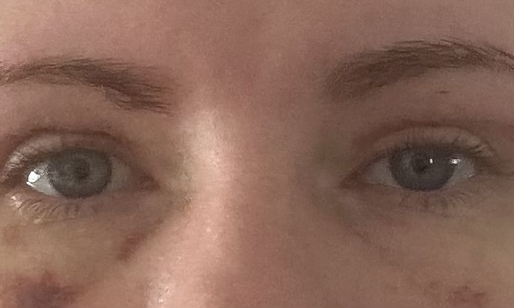 Asymmetrie nach Oberlidstraffung - 82194