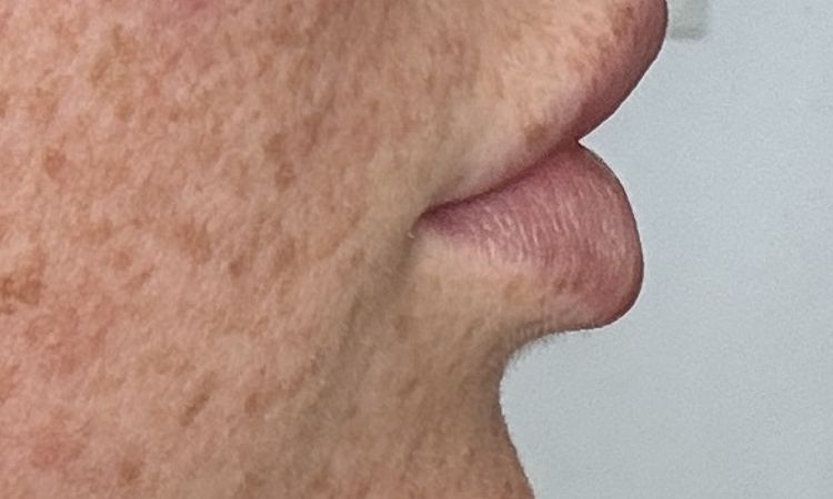 Schnabellippen nach hyalouron behandlung - 82219