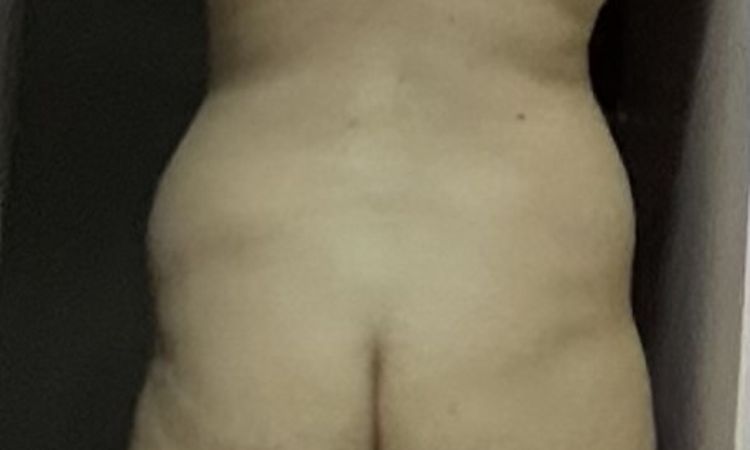Straffung Hüfte möglich? Voraussichtliche Kosten? - 82222