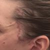 Falte seitlich nach Facelift