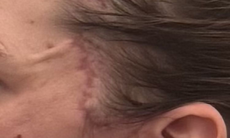 Falte seitlich nach Facelift - 82240