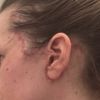 Falte seitlich nach Facelift