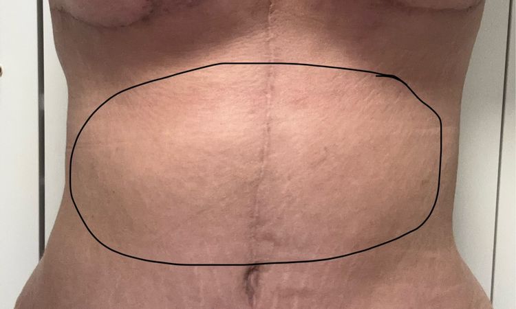 Frage zur anhaltenden Schwellung nach Brust- und Bauchstraffung - 82245