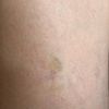 Matting nach Nd:YAG Laser behandelbar?
