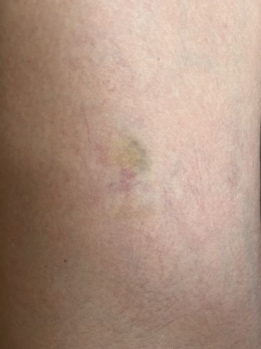 Matting nach Nd:YAG Laser behandelbar?