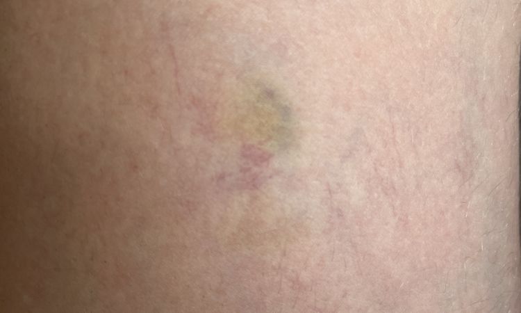 Matting nach Nd:YAG Laser behandelbar? - 82266