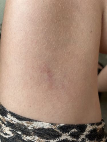 Matting nach Nd:YAG Laser behandelbar?