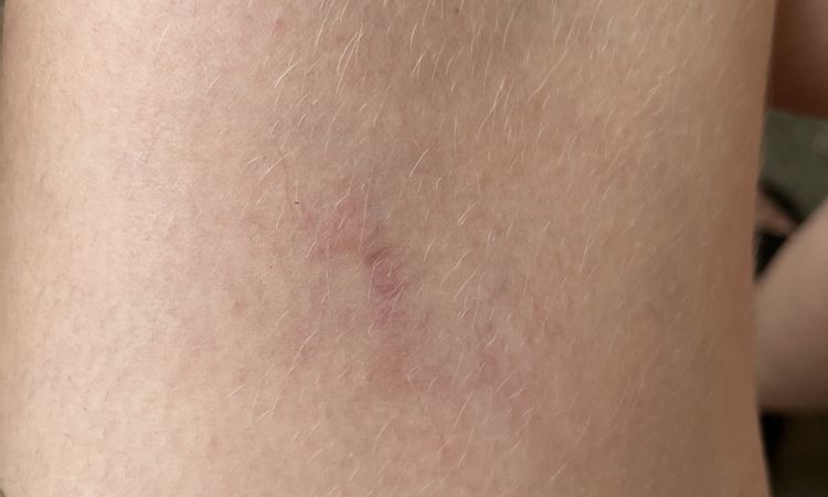 Matting nach Nd:YAG Laser behandelbar? - 82267