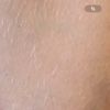 Matting nach Nd:YAG Laser behandelbar?