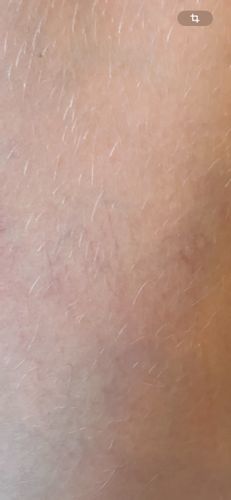 Matting nach Nd:YAG Laser behandelbar?