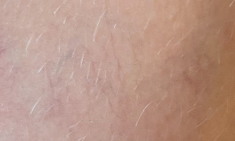 Matting nach Nd:YAG Laser behandelbar? - 82268
