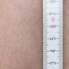 Matting nach Nd:YAG Laser behandelbar?