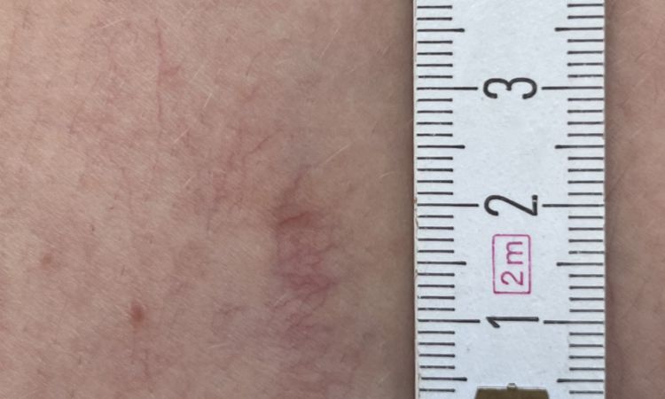 Matting nach Nd:YAG Laser behandelbar? - 82269