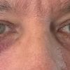 Asymmetrie nach Unterlid-Blepharoplastik mit Kanthopexie