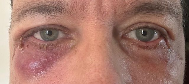 Asymmetrie nach Unterlid-Blepharoplastik mit Kanthopexie - 82299