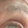 Asymmetrie nach Unterlid-Blepharoplastik mit Kanthopexie