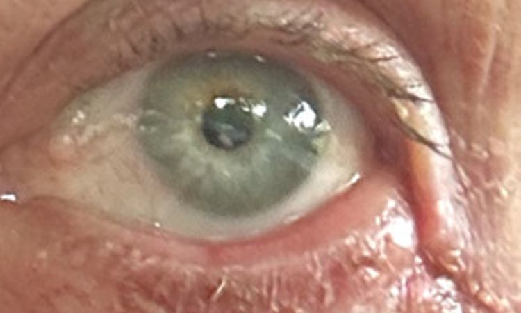 Asymmetrie nach Unterlid-Blepharoplastik mit Kanthopexie - 82300