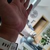 Kapaltunnel op nach 5 wochen dicke hand