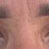Oberlidstraffung: 12 Tage nach Op immer noch Schlupflider + asymmetrisch
