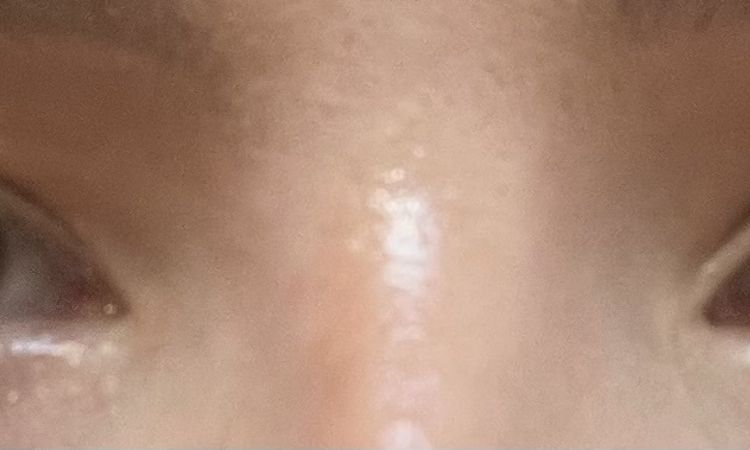 Was kann ich gegen meine ungleichen Augenlider tun? - 82339