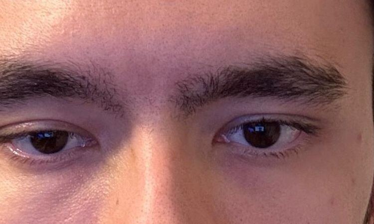 Asymmetrie zwischen rechtem und linkem Auge – Beratungsmöglichkeiten - 82403