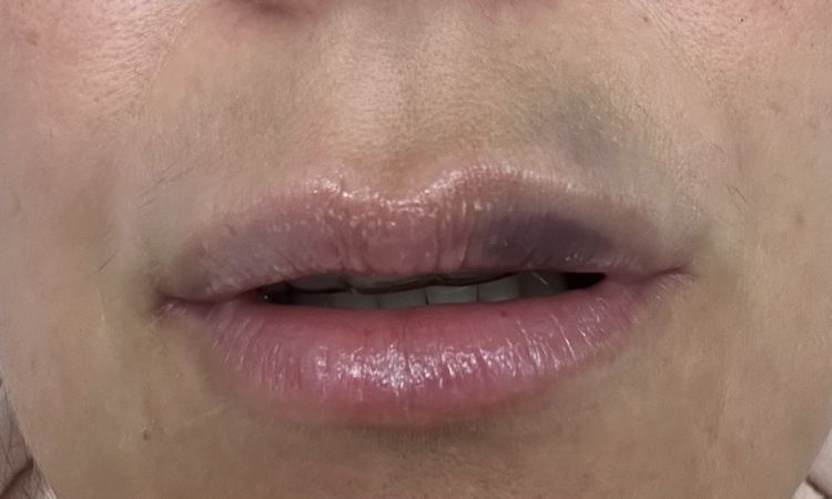 Bräuche Verfärbung Lippen nach Hyaluron - 82447