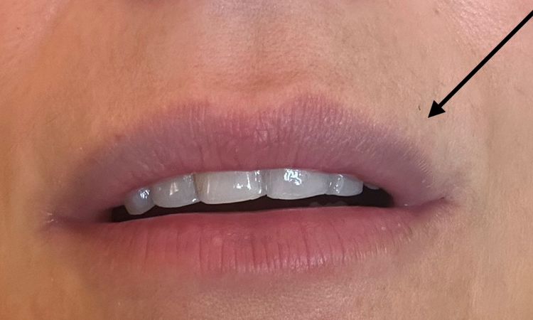 Bräuche Verfärbung Lippen nach Hyaluron - 82448