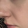 Ist der Co2laser die beste Option für mein Gesicht?