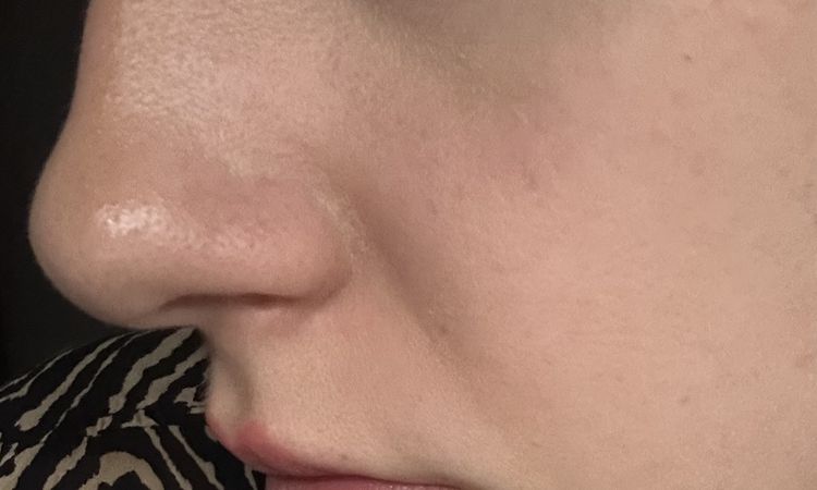 Ist der Co2laser die beste Option für mein Gesicht? - 82481