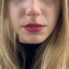 Ist der Co2laser die beste Option für mein Gesicht?
