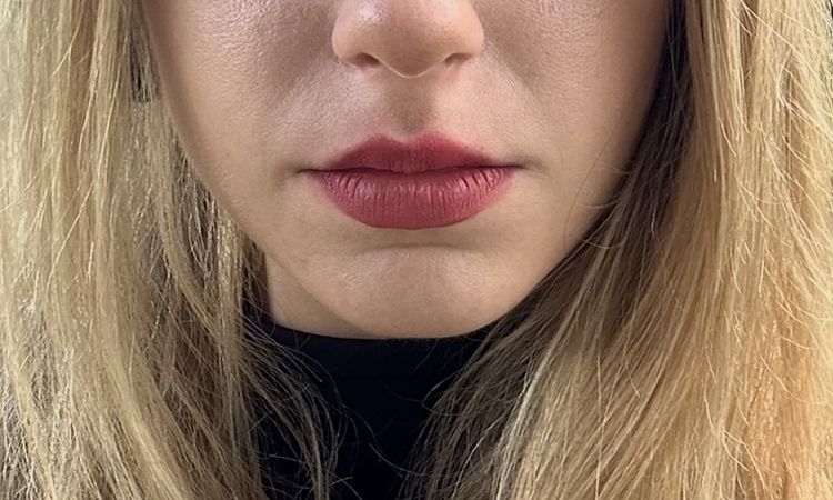 Ist der Co2laser die beste Option für mein Gesicht? - 82482