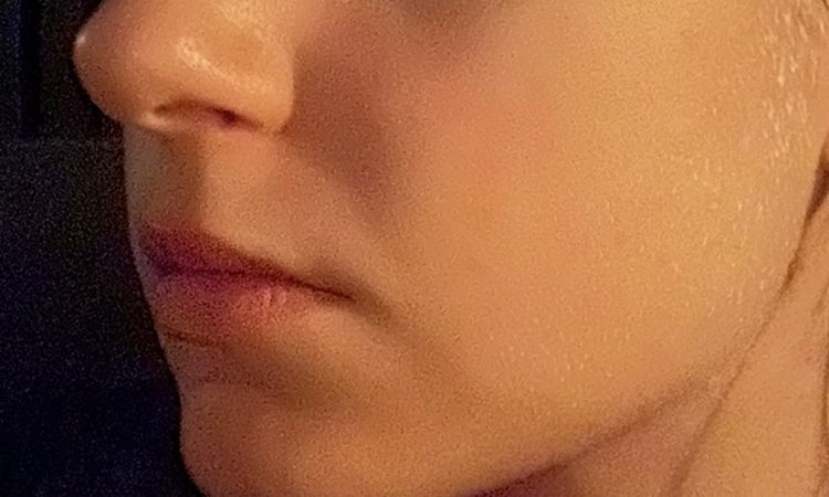 Ist der Co2laser die beste Option für mein Gesicht? - 82483