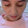 2 Wochen nach Septorhinoplastik starke asymmetrische Nase