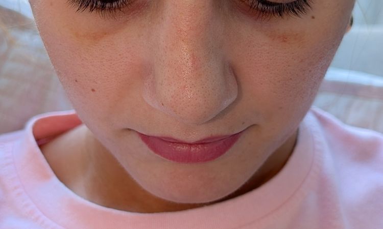 2 Wochen nach Septorhinoplastik starke asymmetrische Nase - 82488