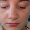 2 Wochen nach Septorhinoplastik starke asymmetrische Nase