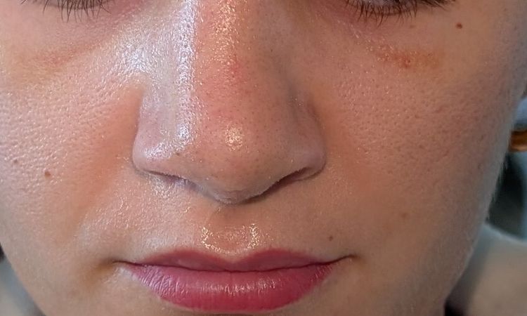2 Wochen nach Septorhinoplastik starke asymmetrische Nase - 82489
