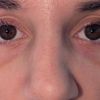 2 Wochen nach Septorhinoplastik starke asymmetrische Nase