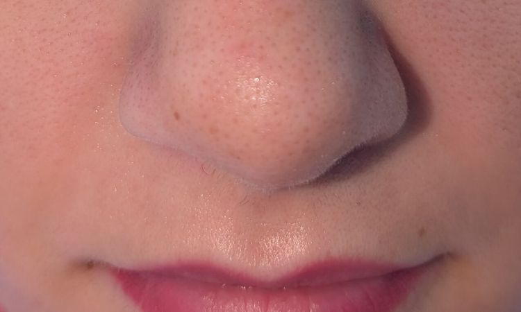 2 Wochen nach Septorhinoplastik starke asymmetrische Nase - 82490