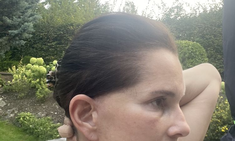 Abstehende ohren und fehlender haaransatz nach hals facelift - 82504